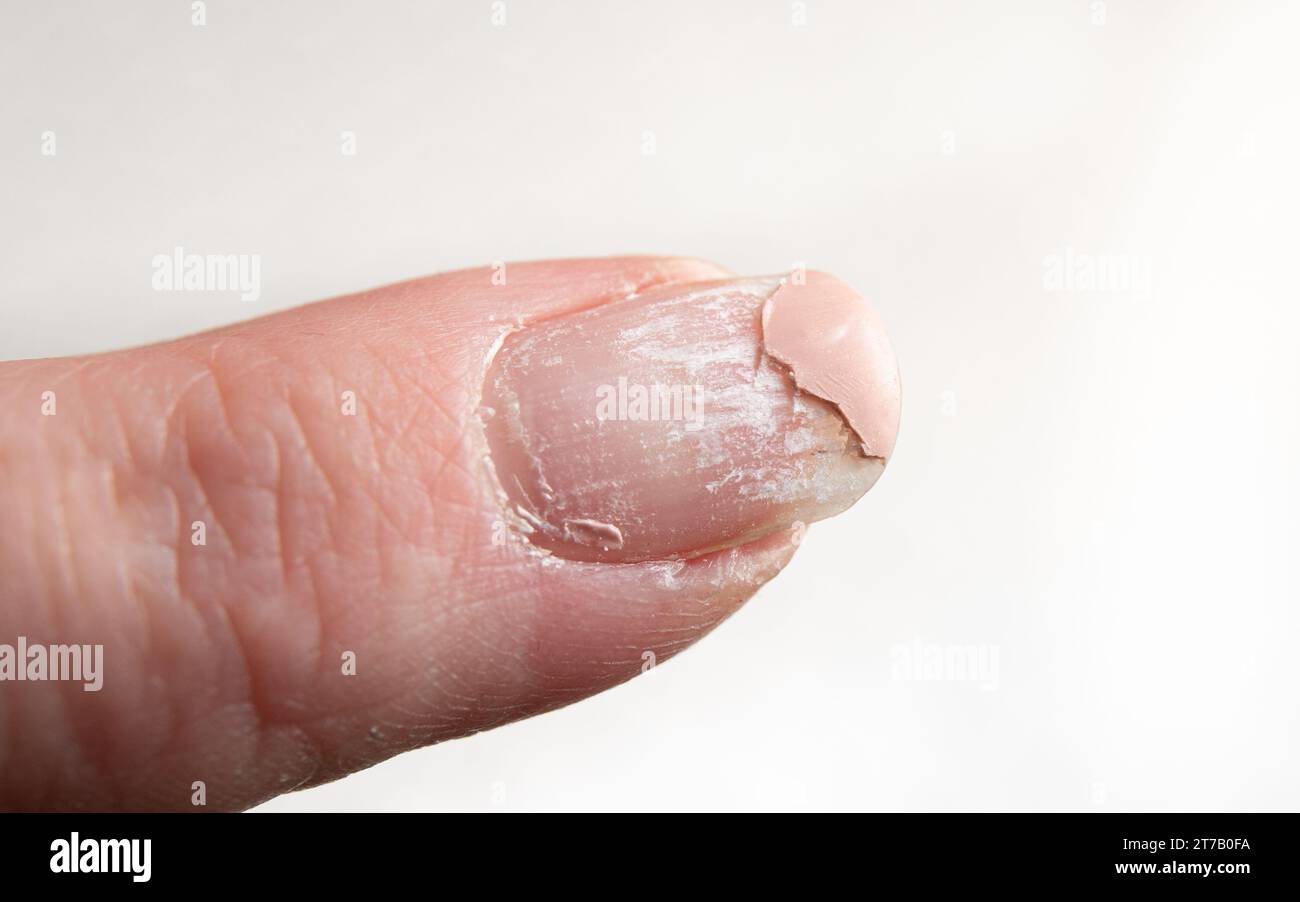 Vista ravvicinata degli strati che si staccano da unghie danneggiate dopo l'uso di smalto UV. Casa al chiuso. Foto Stock