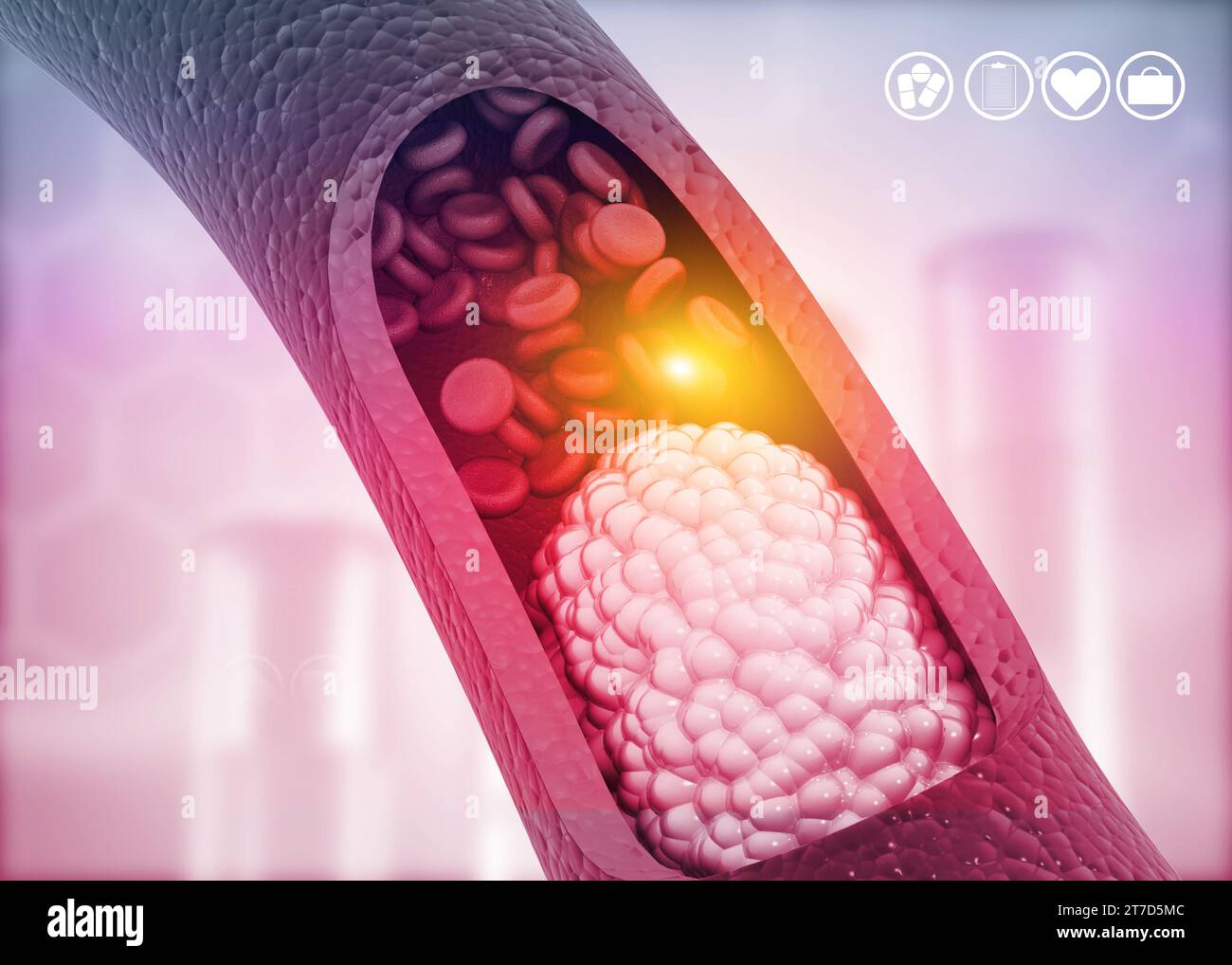 Aterosclerosi, placca di colesterolo nell'arteria. illustrazione 3d. Foto Stock