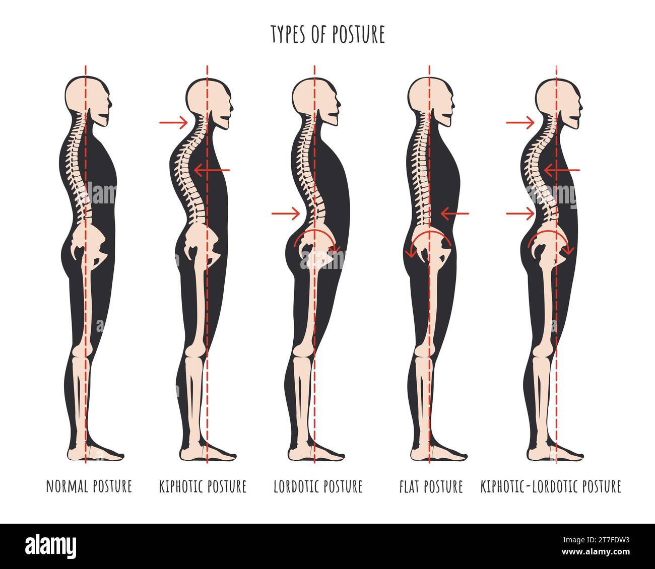 Tipo di postura, infografica sulle sindromi posturali. Campioni scheletrici di cifosi problema alla schiena, lordosi e schiena piatta. Poster educativo medico postura normale. Illustrazione vettoriale. Illustrazione Vettoriale