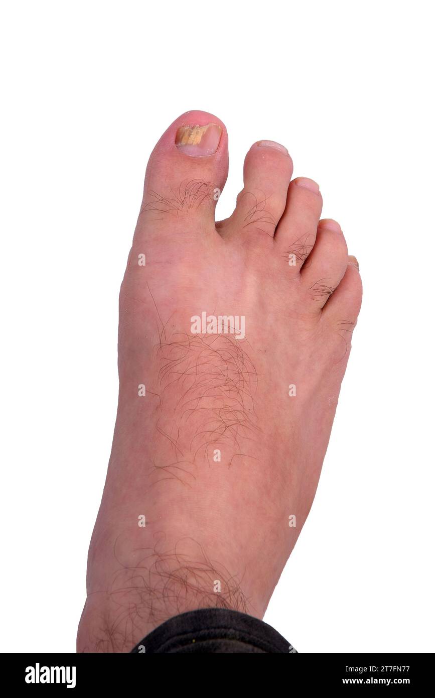 Infezione da funghi ungueali sul piede grosso. Infezione fungina sulle unghie del piede con onicomicosi della tigna, risultato della malattia Foto Stock
