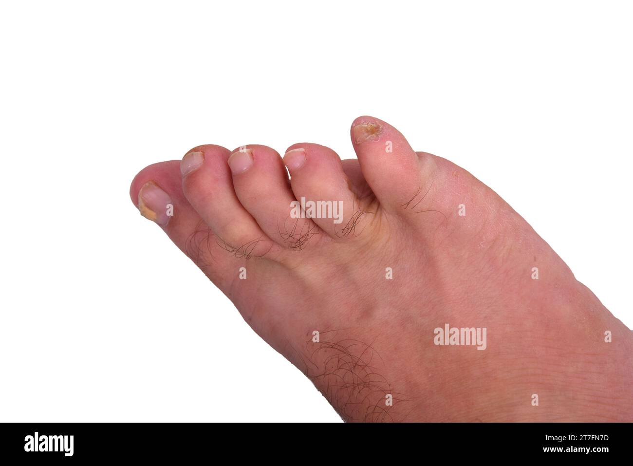 Infezione da funghi ungueali sul piede grosso. Infezione fungina sulle unghie del piede con onicomicosi della tigna, risultato della malattia Foto Stock