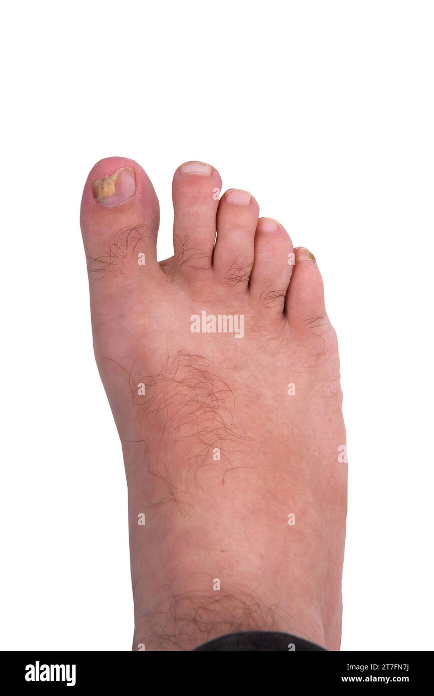 Infezione da funghi ungueali sul piede grosso. Infezione fungina sulle unghie del piede con onicomicosi della tigna, risultato della malattia Foto Stock
