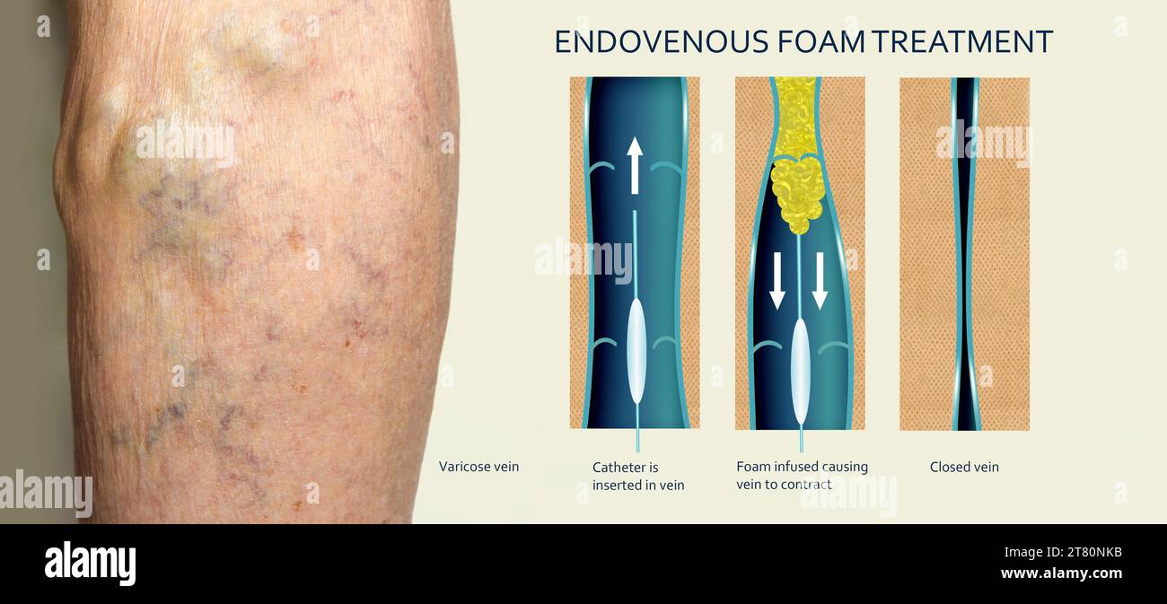 Trattamento laser endovenoso per vene varicose - concetto di scleroterapia della schiuma. Prima e dopo. Struttura venosa Foto Stock