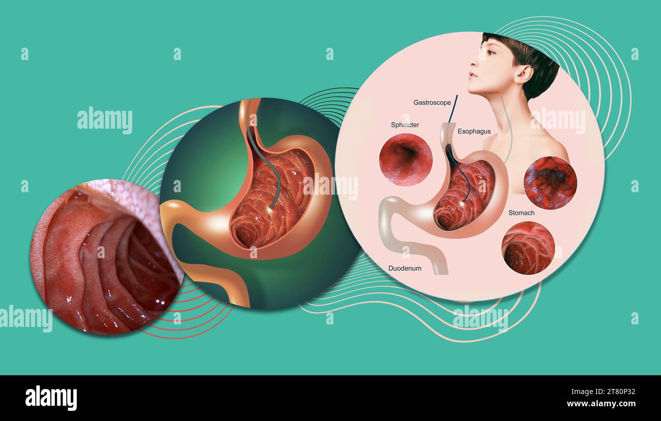 Endoscopia digestiva o gastroscopia. Esecuzione di una procedura di gastroscopia. Diagnosi di malattie gastriche. Salute dello stomaco. Concetto medico Foto Stock
