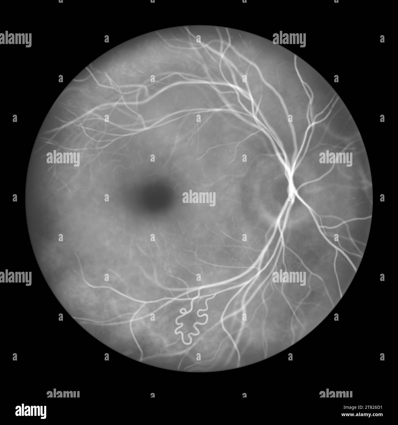 Malformazione arterovenosa retinica, illustrazione Foto Stock