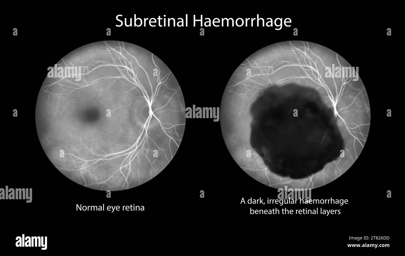 Emorragia subretinica sulla retina, illustrazione Foto Stock