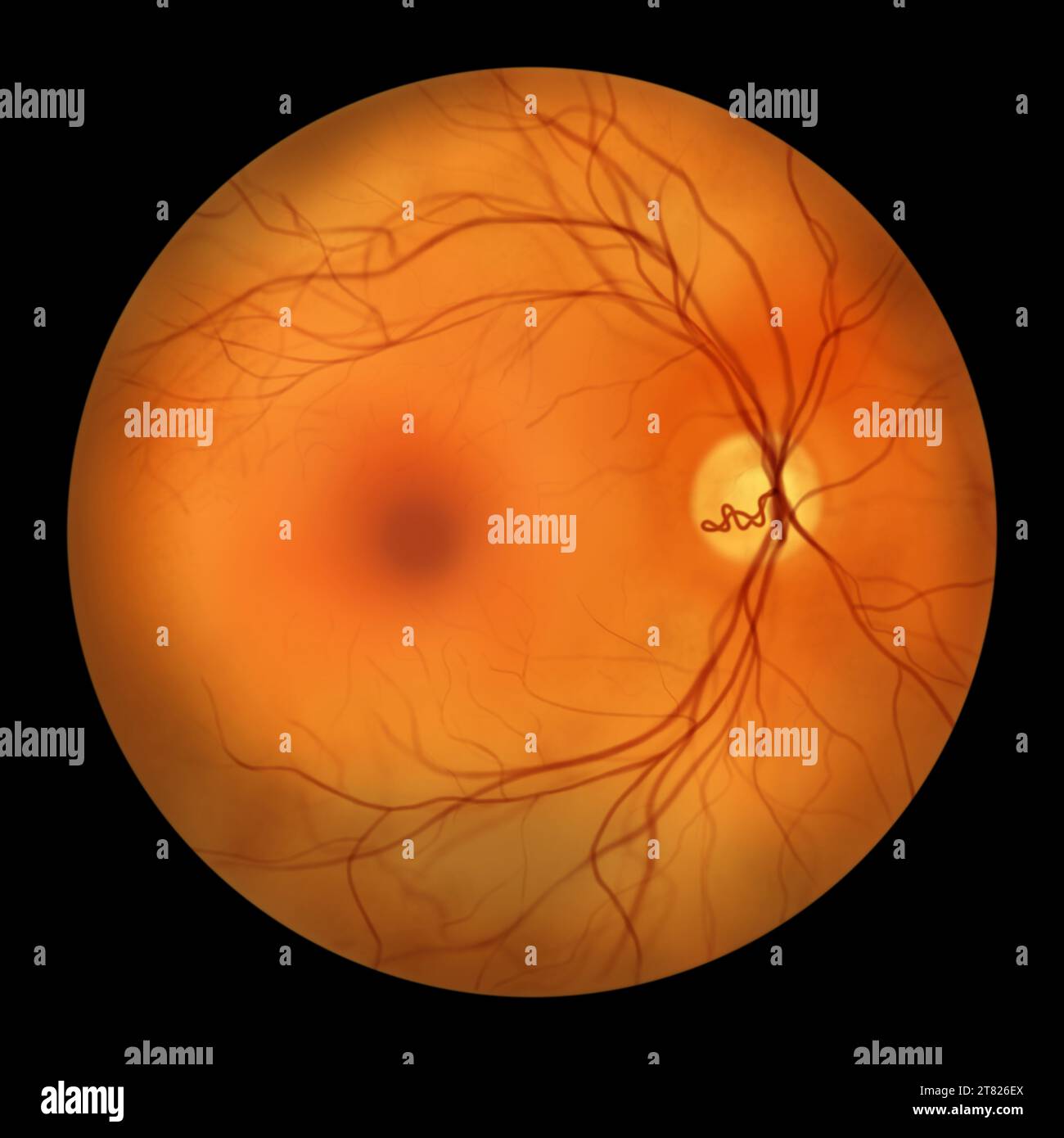 Illustrazione di un loop vascolare prepapillare sulla retina, come osservato durante l'oftalmoscopia, che mostra i vasi sanguigni in loop intorno all'ottica d Foto Stock