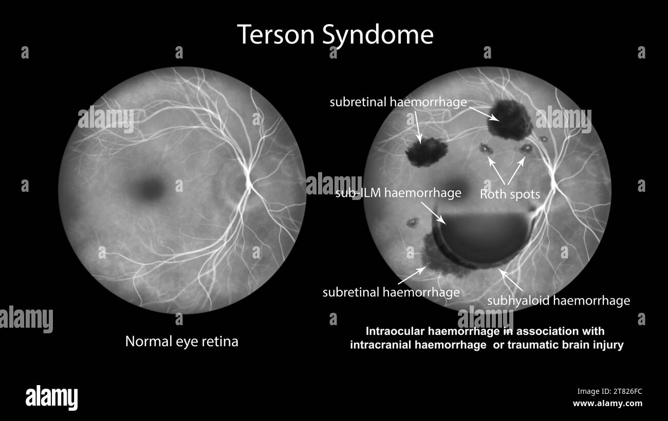 Emorragia intraoculare nella sindrome di Terson, illustrazione Foto Stock