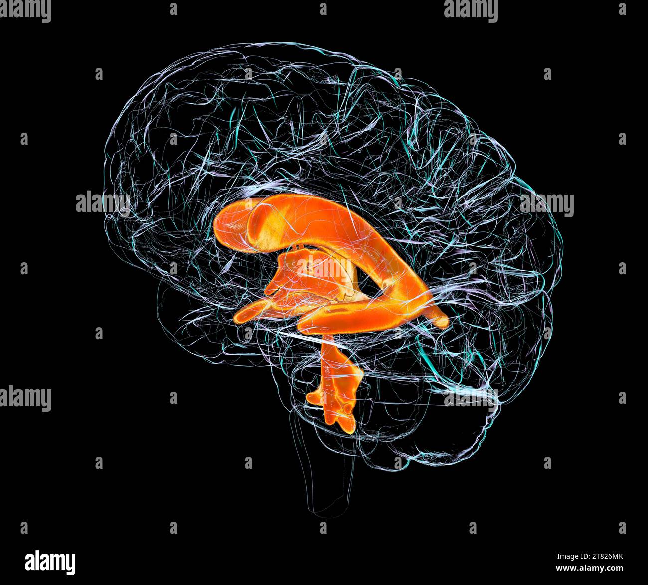 Sistema ventricolare del cervello di un bambino, illustrazione Foto Stock