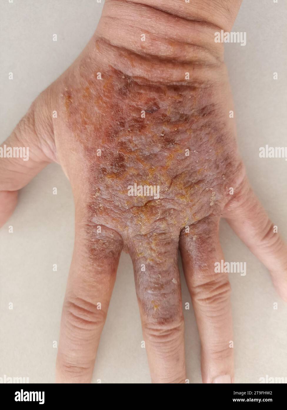 eruzione cutanea eczema dermatite sulla mano. infiammazione della pelle Foto Stock