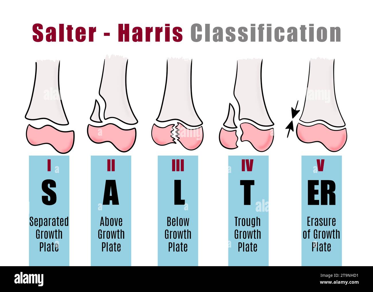 Salter - classificazione Harris per riconoscere e identificare diversi tipi di fratture ossee. Illustrazione per gli studenti Foto Stock