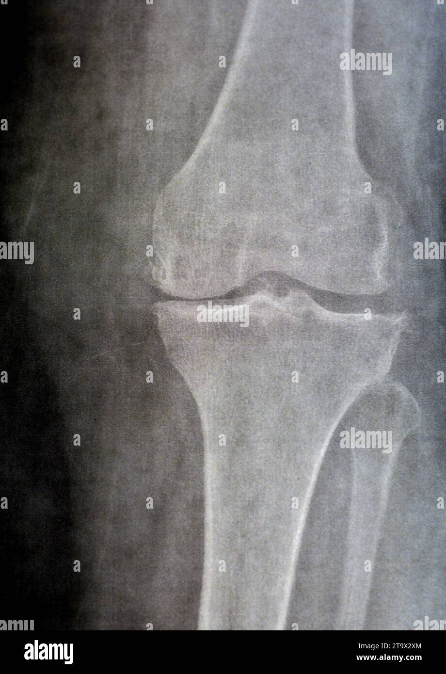 La radiografia semplice del ginocchio sinistro mostra un'apparente osteoartrite articolare secondo il sistema Kellgren e Lawrence per la classificazione dell'osteoartrite con d Foto Stock