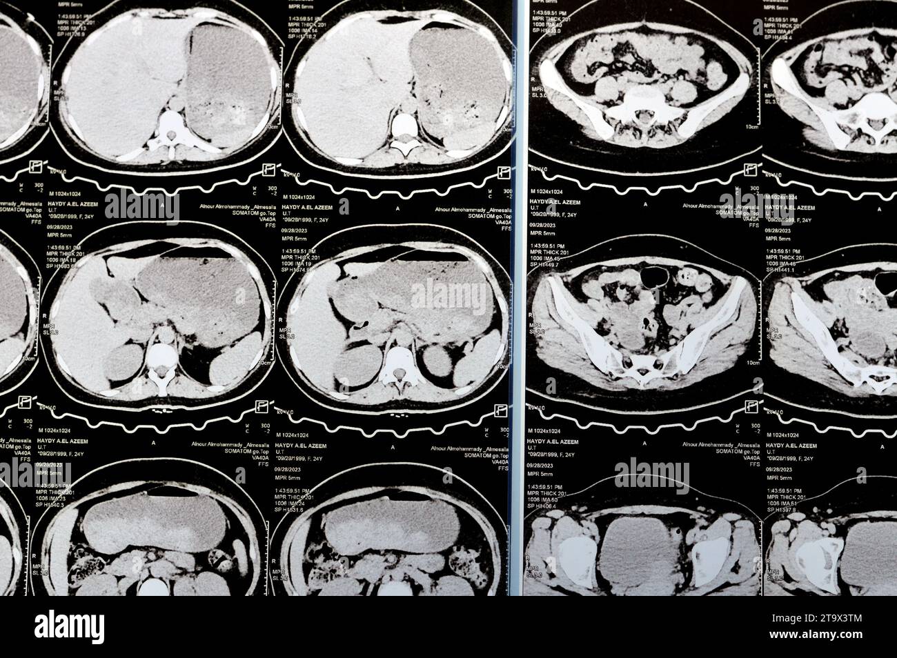 Cairo, Egitto, 3 ottobre 2023: La scansione TC multistrato dell'addome e della pelvi mostra cisti ovarica destra 3 x 3 cm, distensione gassosa del colon, nessuna urinaria di dimensioni notevoli Foto Stock