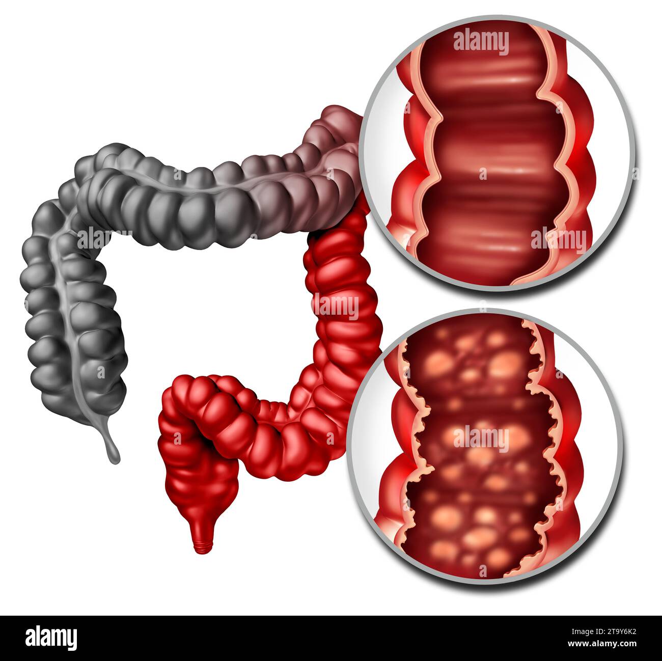 Colite ulcerosa come intestino infiammatorio con malattia intestinale interna sana e ulcerata rivestimento con un retto umano e colon come digestivo Foto Stock