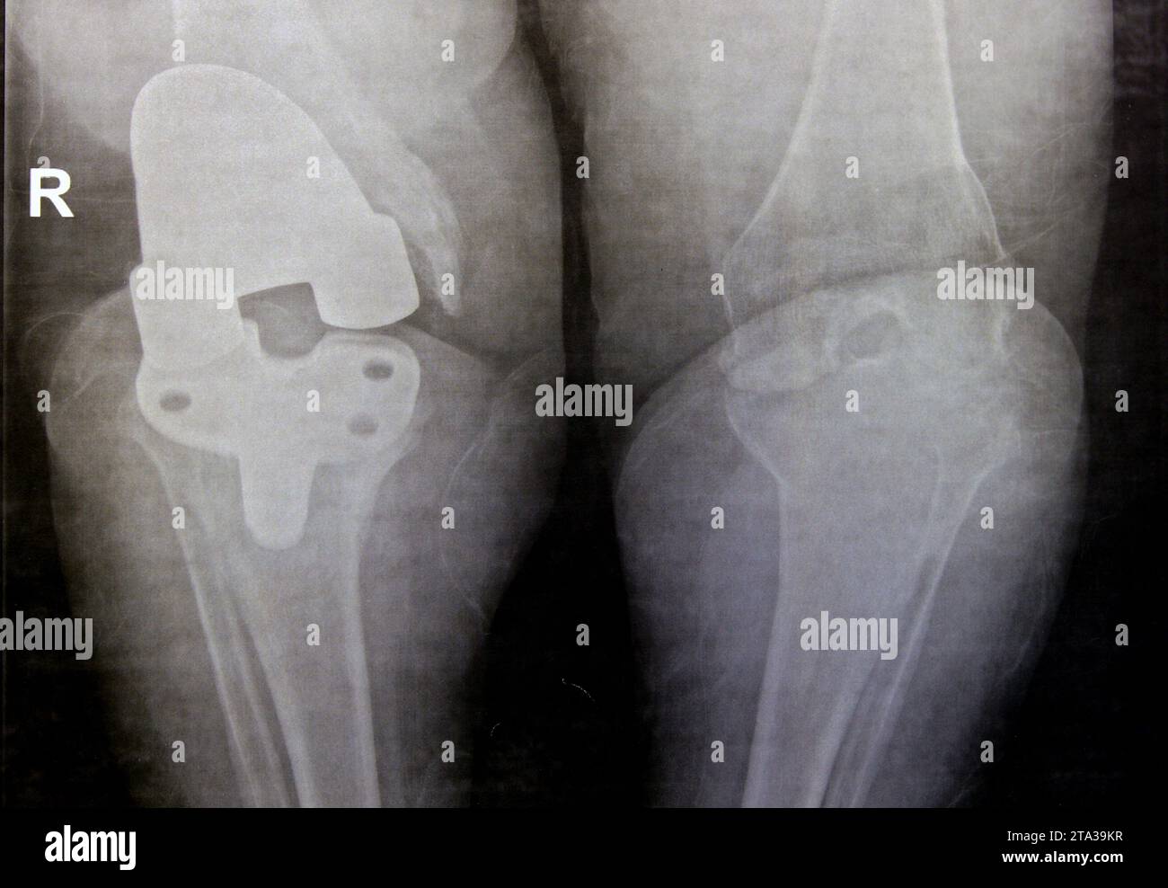 Radiografia semplice delle articolazioni del ginocchio, il lato destro mostra l'artroplastica totale di sostituzione del ginocchio dopo l'osteoartrite articolare di grado 4, una procedura chirurgica per sostituire il t Foto Stock