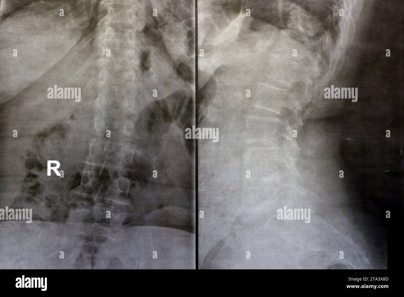 La radiografia liscia della colonna dorsale e del legname rivela alterazioni spondilotiche, raddrizzamento della dorsale e della colonna vertebrale legnale, gli spazi dei dischi intervertebrali sono intatti, Foto Stock