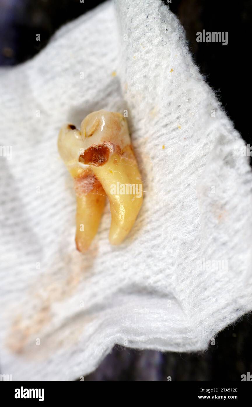 Saggezza estratta ottavo dente inferiore destro con un dente decadono, dopo nervo esposto e dolore grave, gonfiore e infiammazione, i denti di saggezza sono i molari Foto Stock