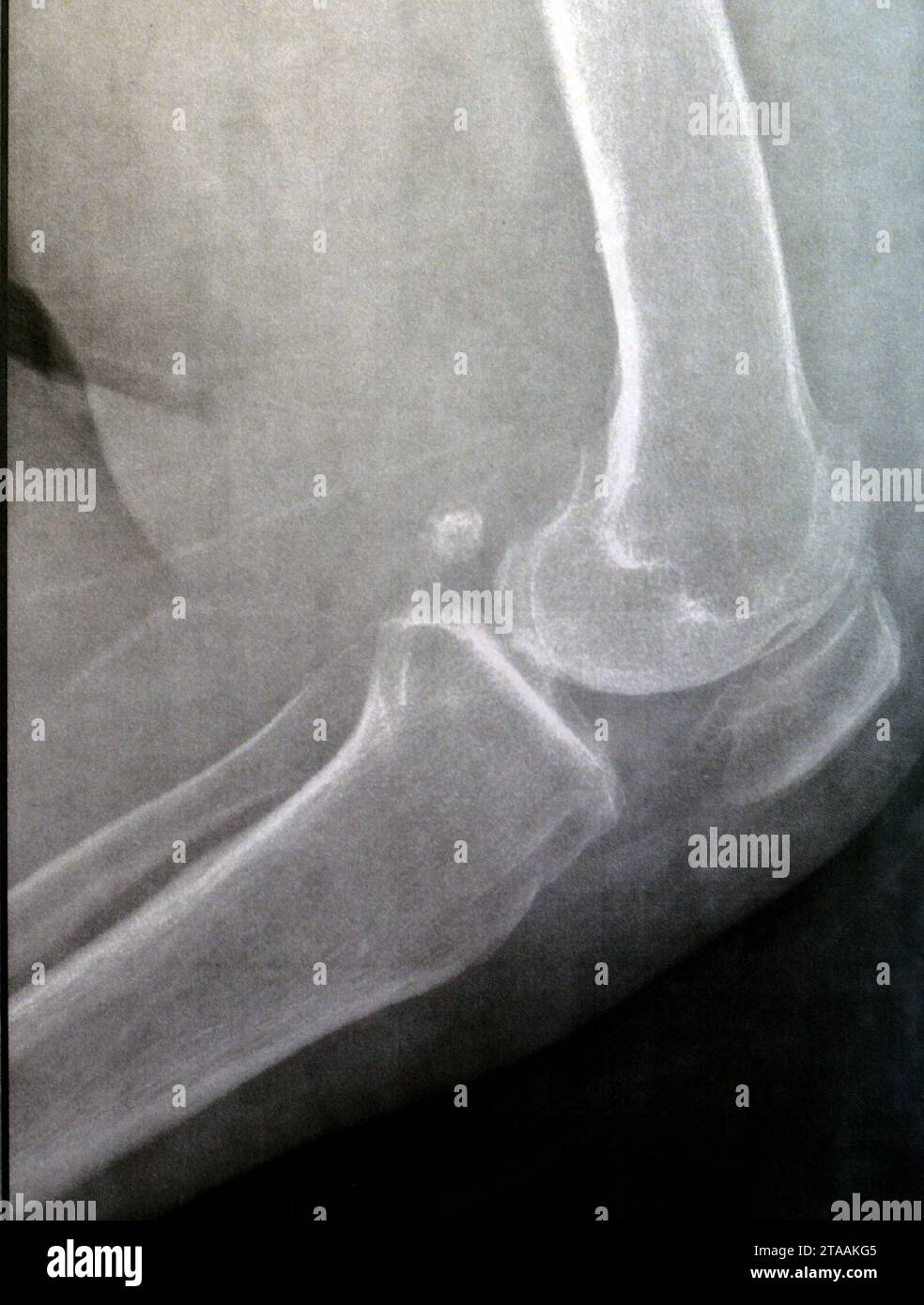 La radiografia semplice del ginocchio sinistro mostra un'apparente osteoartrite articolare secondo il sistema Kellgren e Lawrence per la classificazione dell'osteoartrite con d Foto Stock