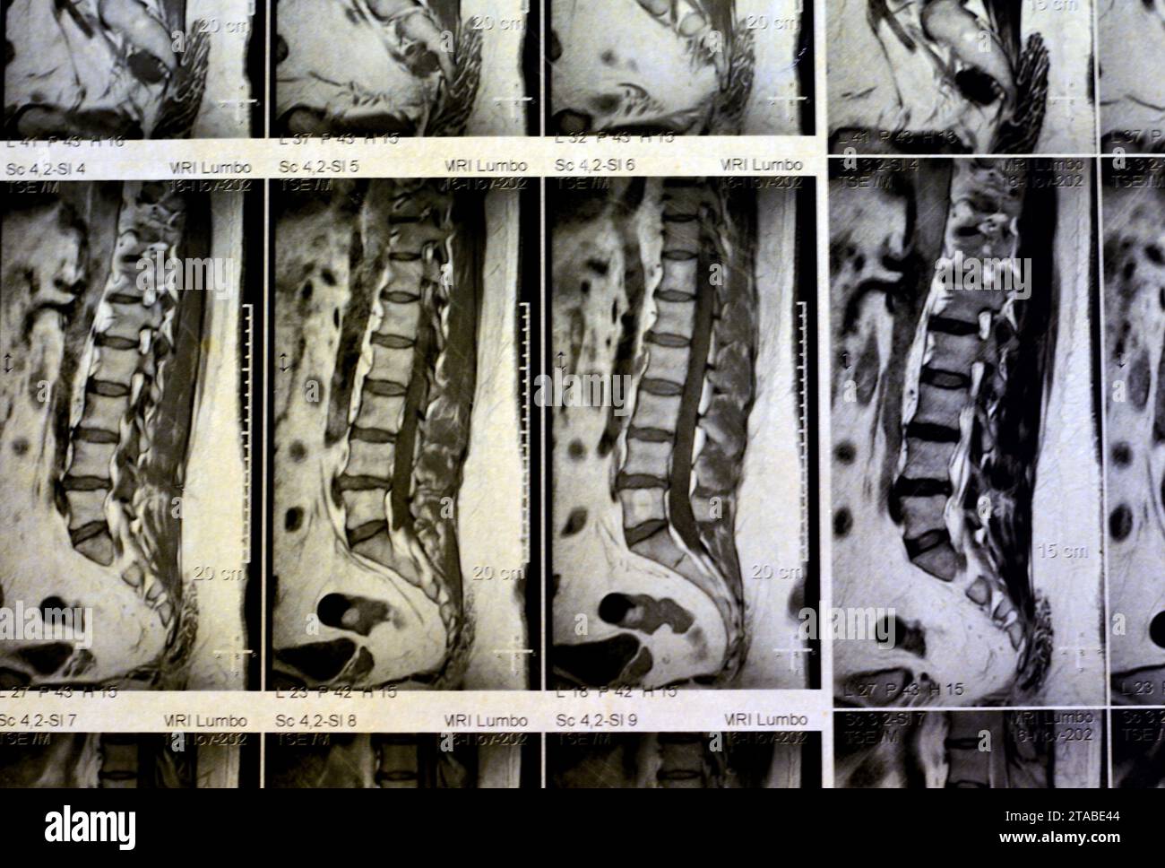 RM colonna lombosacrale senza contrasto spasmo muscolare schiena rivelato, lievi lesioni del disco L3-L4, L4-L5, corpi vertebrali sacrali, L5 e T12 emangiomata, Foto Stock