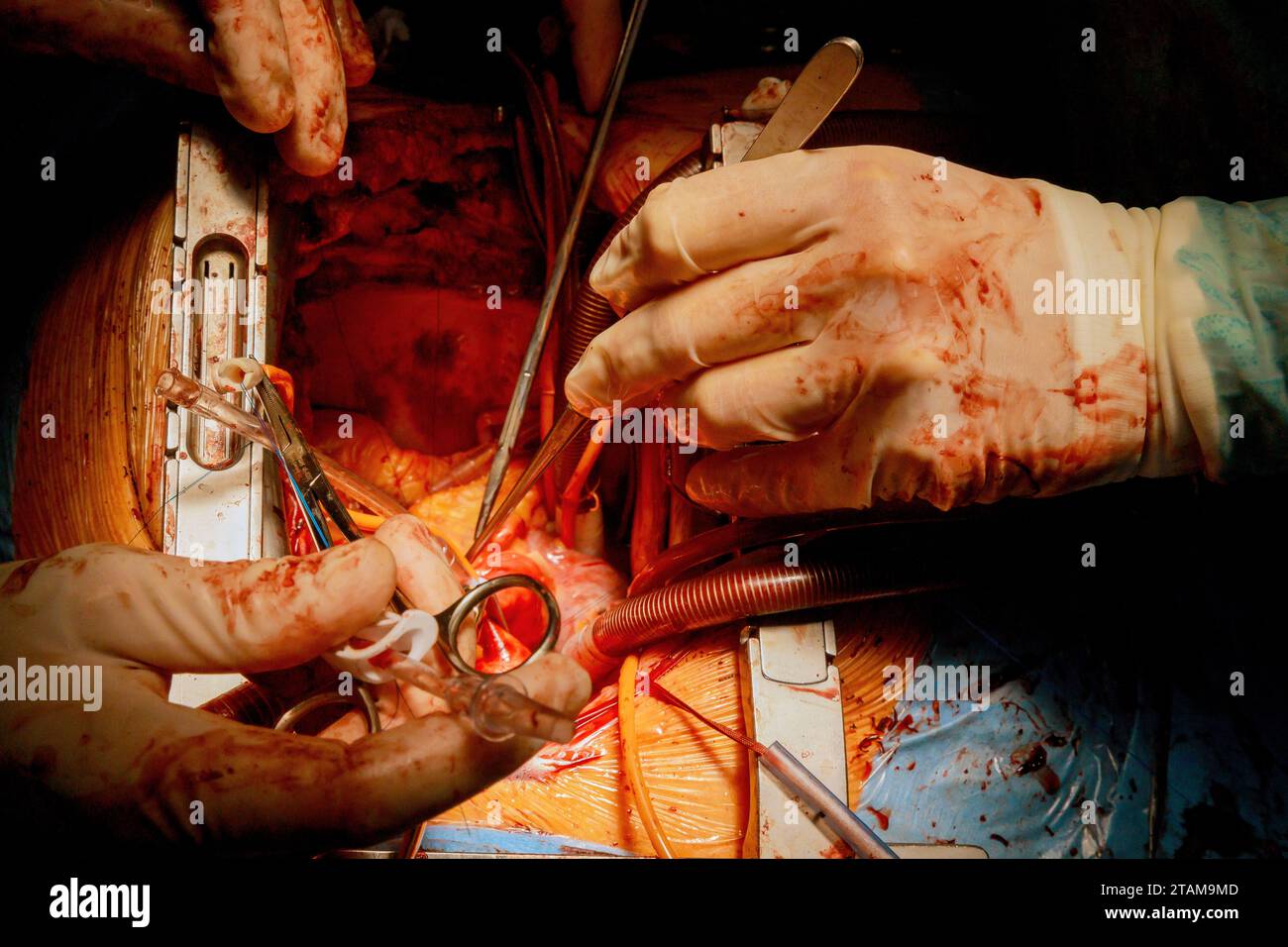 Paziente durante la procedura chirurgica a cuore aperto nella sala operatoria Foto Stock