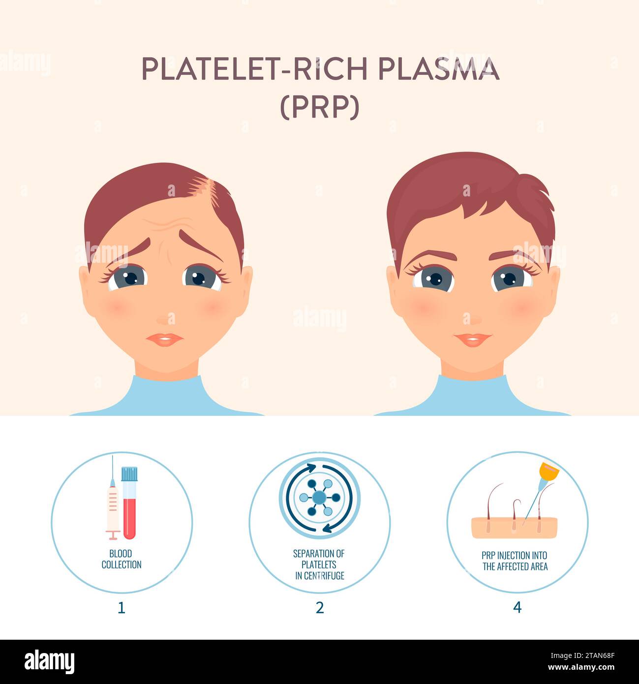 Trattamento dei capelli PRP, illustrazione concettuale Foto Stock