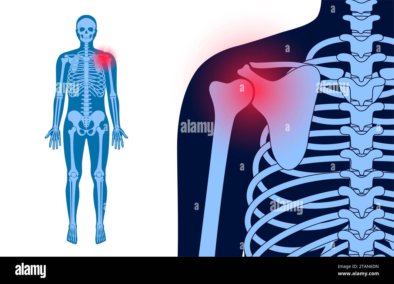 Dolore alla spalla, illustrazione concettuale Foto Stock