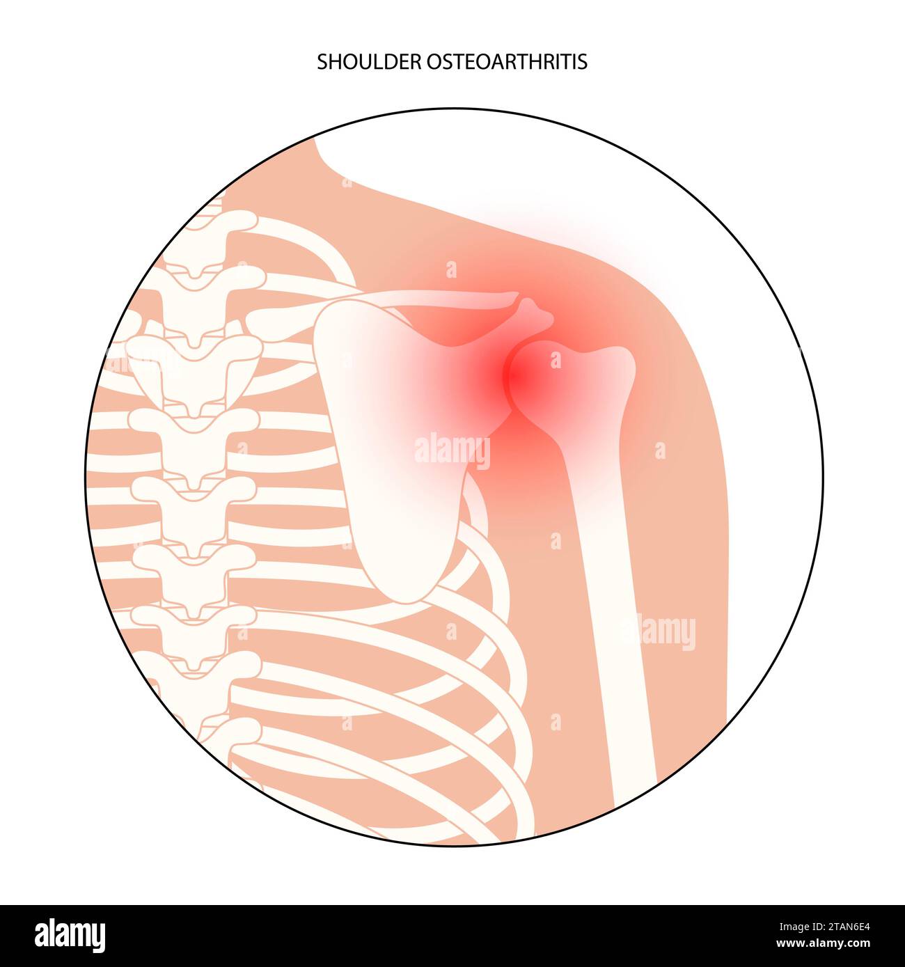 Dolore alla spalla, illustrazione concettuale Foto Stock