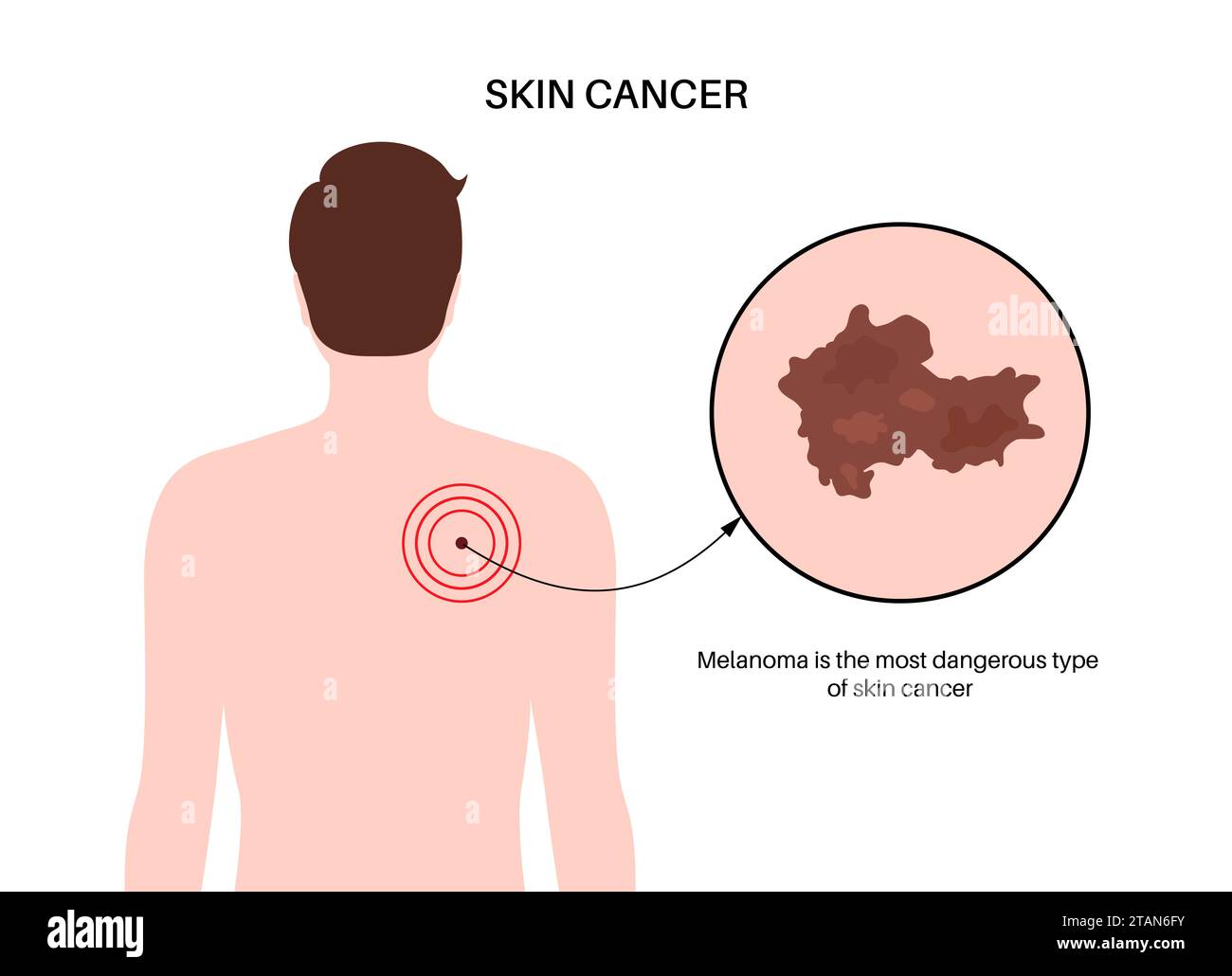 Cancro della pelle, illustrazione Foto Stock