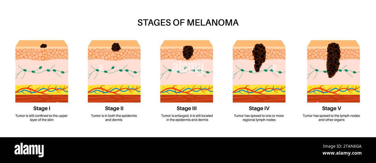 Stadi del melanoma, illustrazione. Foto Stock