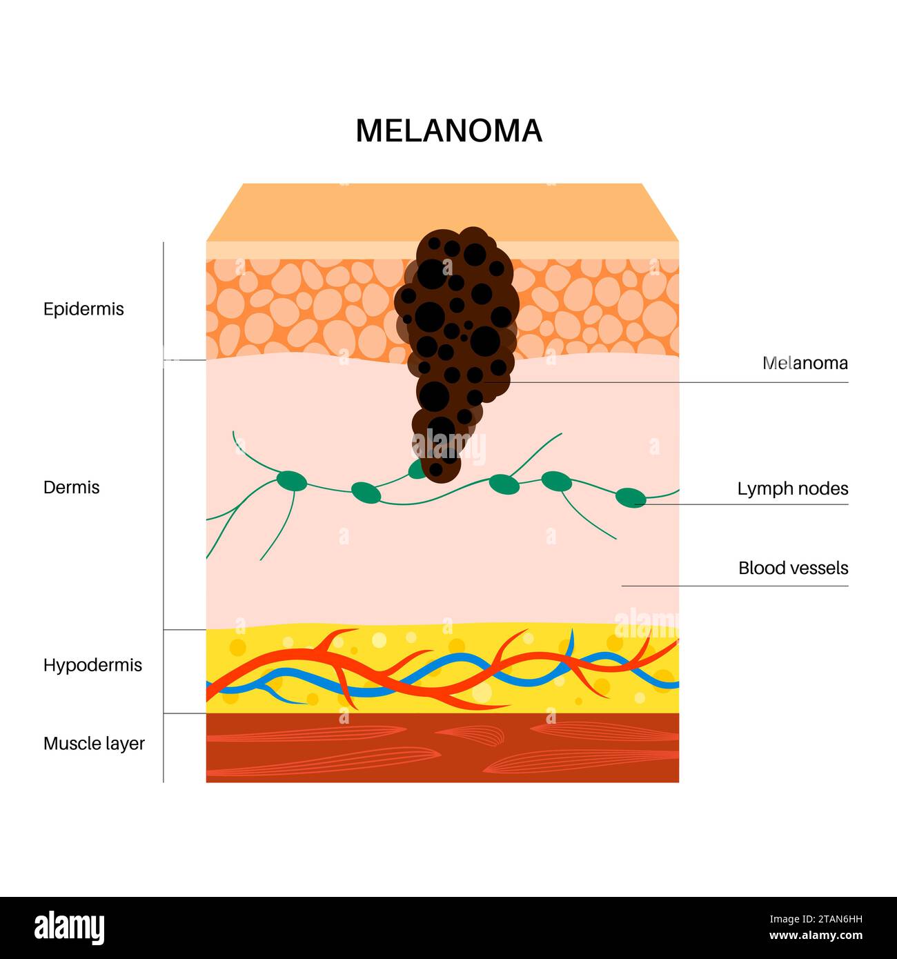 Il melanoma, illustrazione Foto Stock