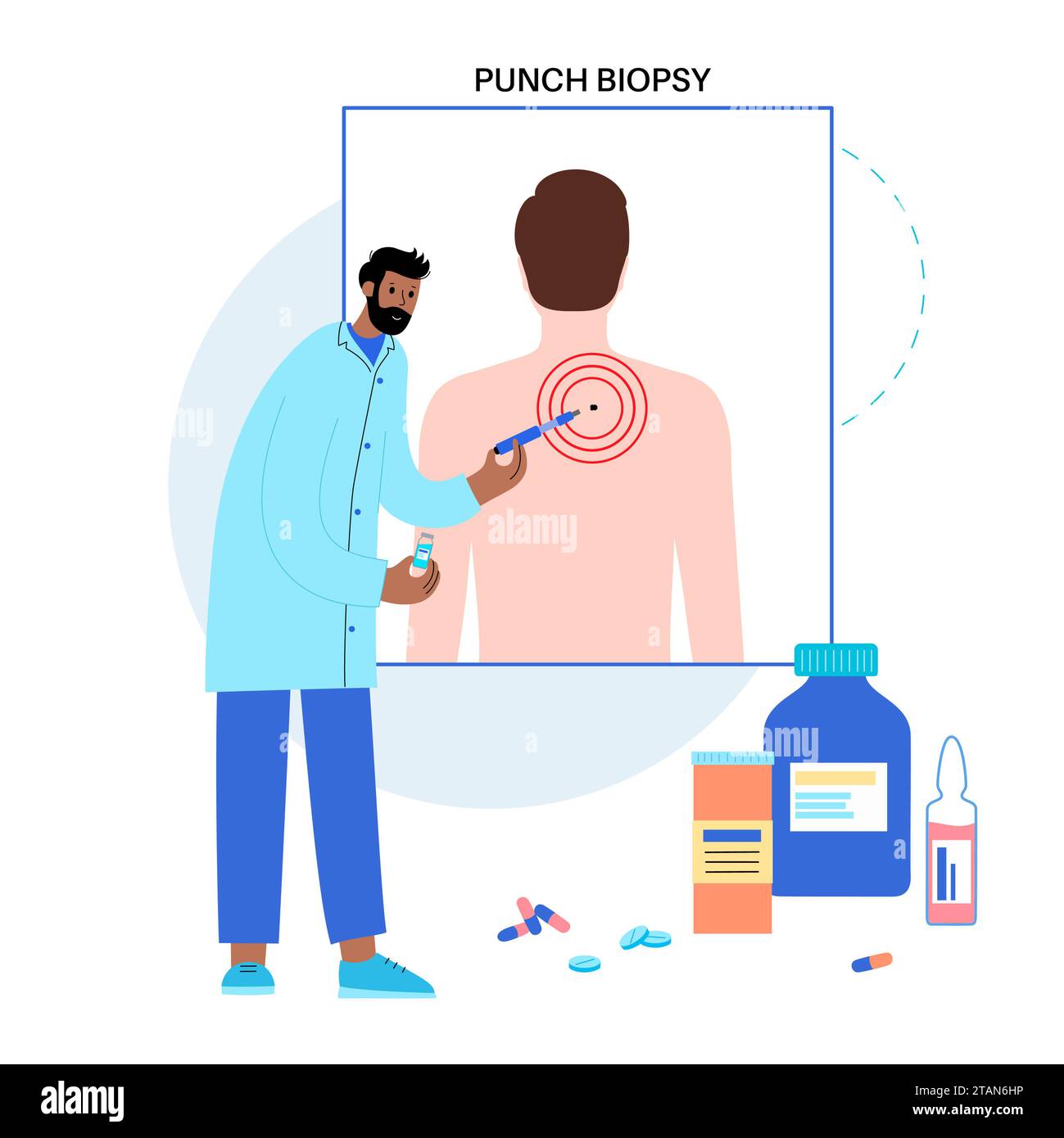 Biopsia punch, illustrazione. Foto Stock
