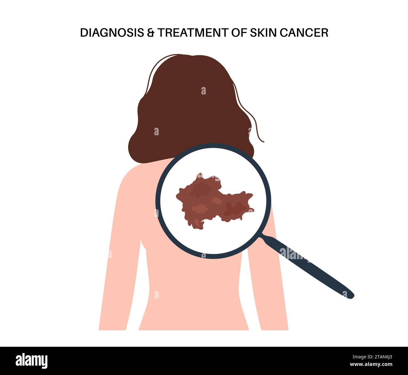 Cancro della pelle, illustrazione Foto Stock