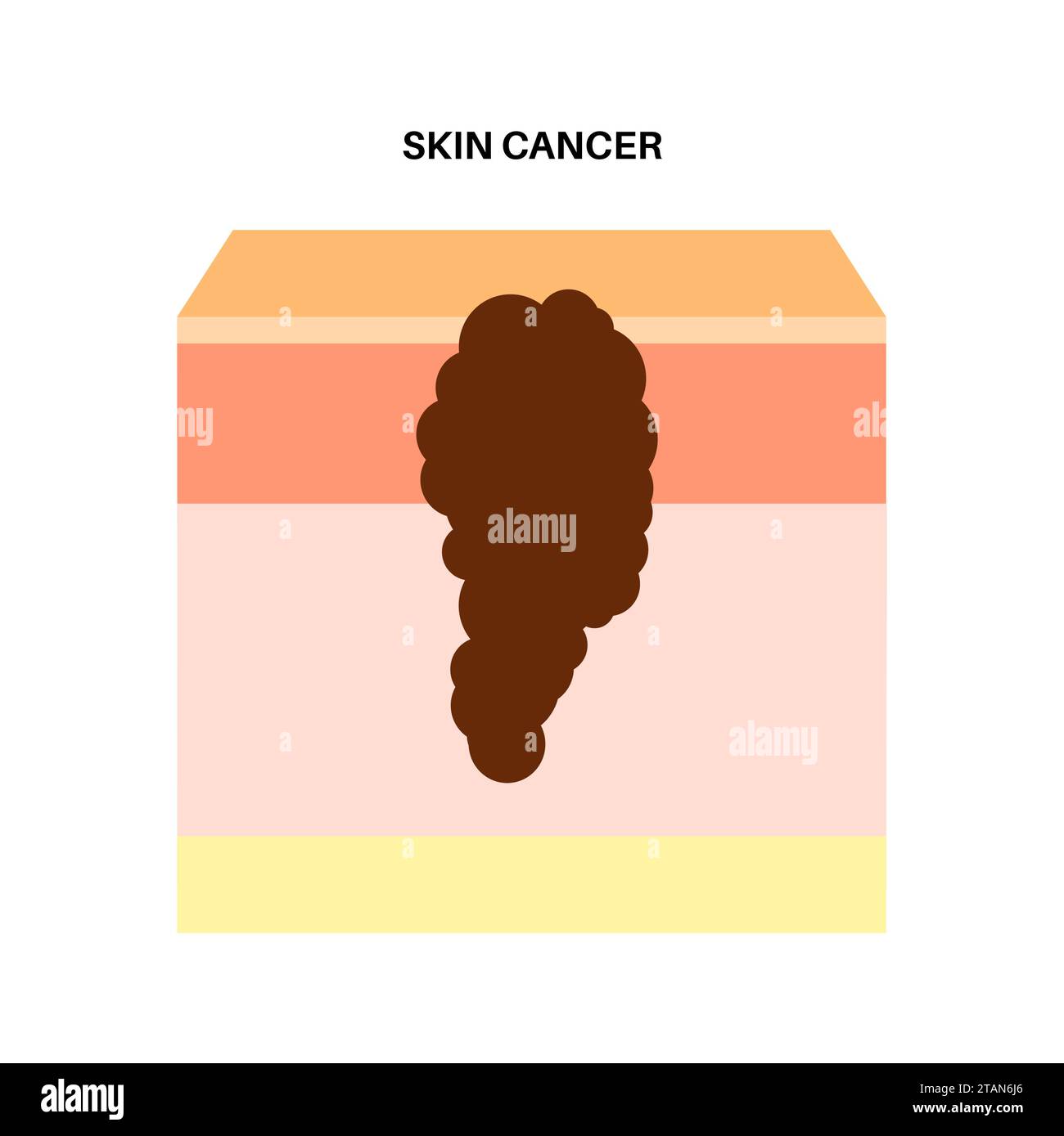 Cancro della pelle, illustrazione Foto Stock