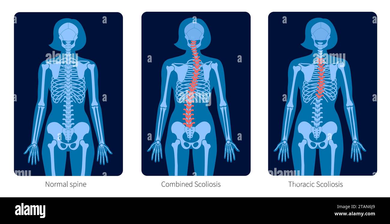 Colonna vertebrale sana e scoliosi, illustrazione Foto Stock