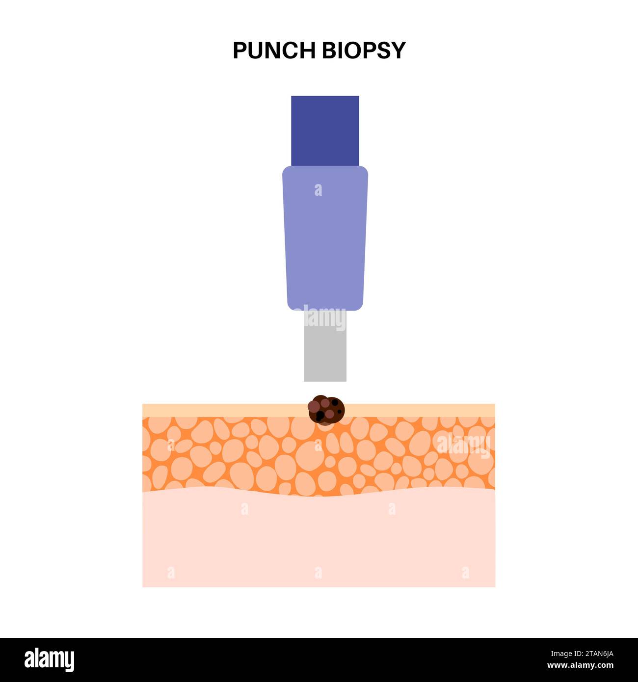 Biopsia punch, illustrazione Foto Stock