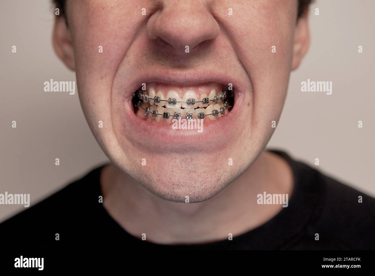 dettagli dei denti reali con staffe in metallo Foto Stock