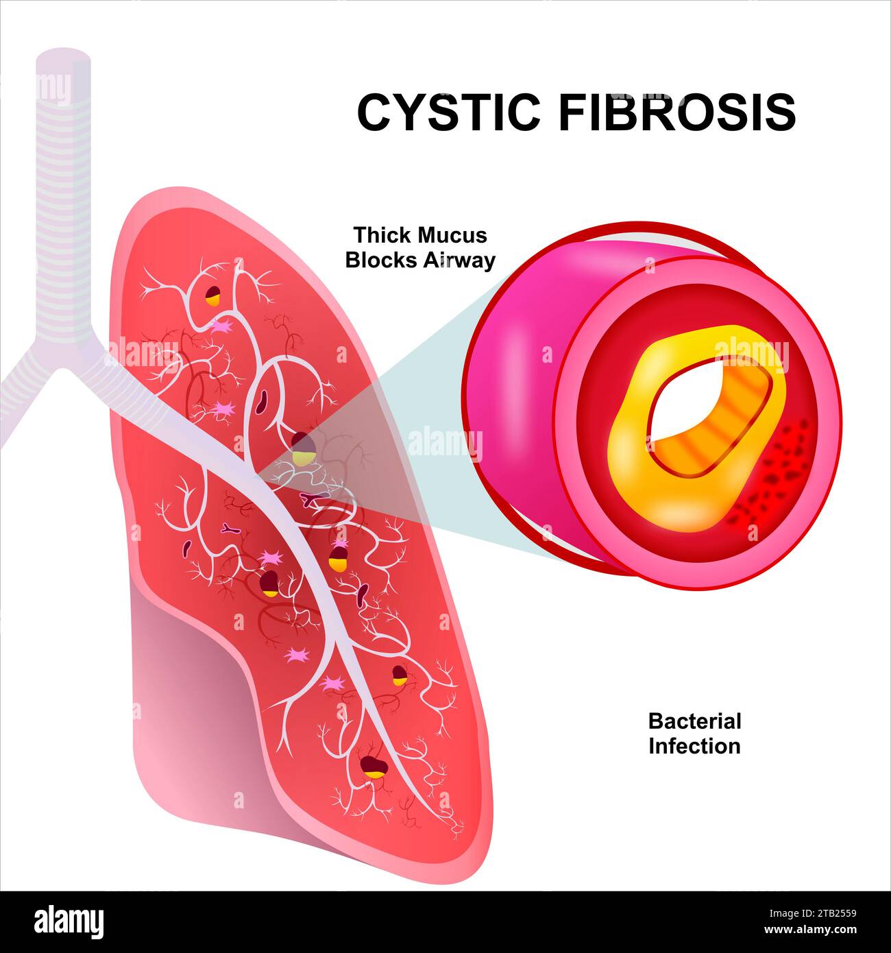 Infezione da illustrazione della fibrosi cistica sui polmoni Foto Stock