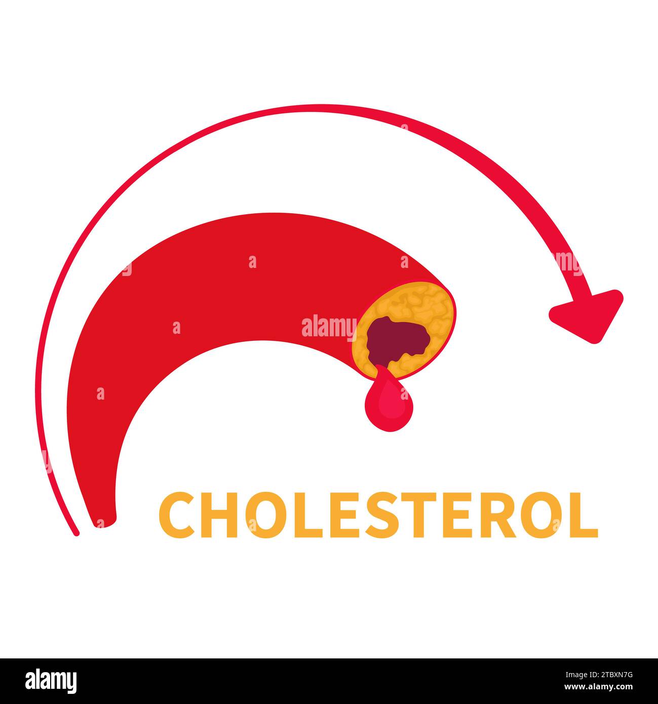 Colesterolo alto, illustrazione concettuale Foto Stock