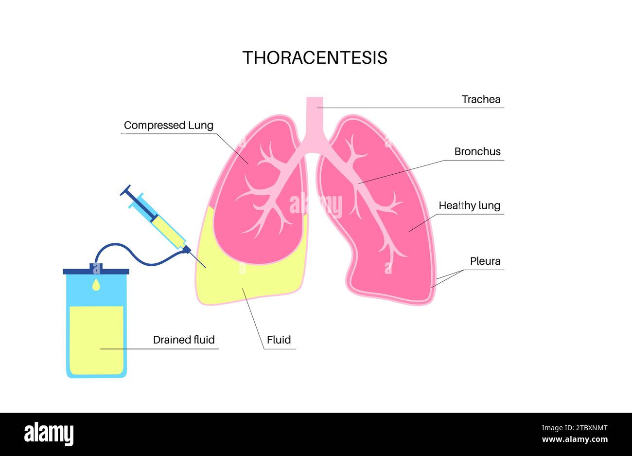 Procedura medica toracentesi, illustrazione Foto Stock