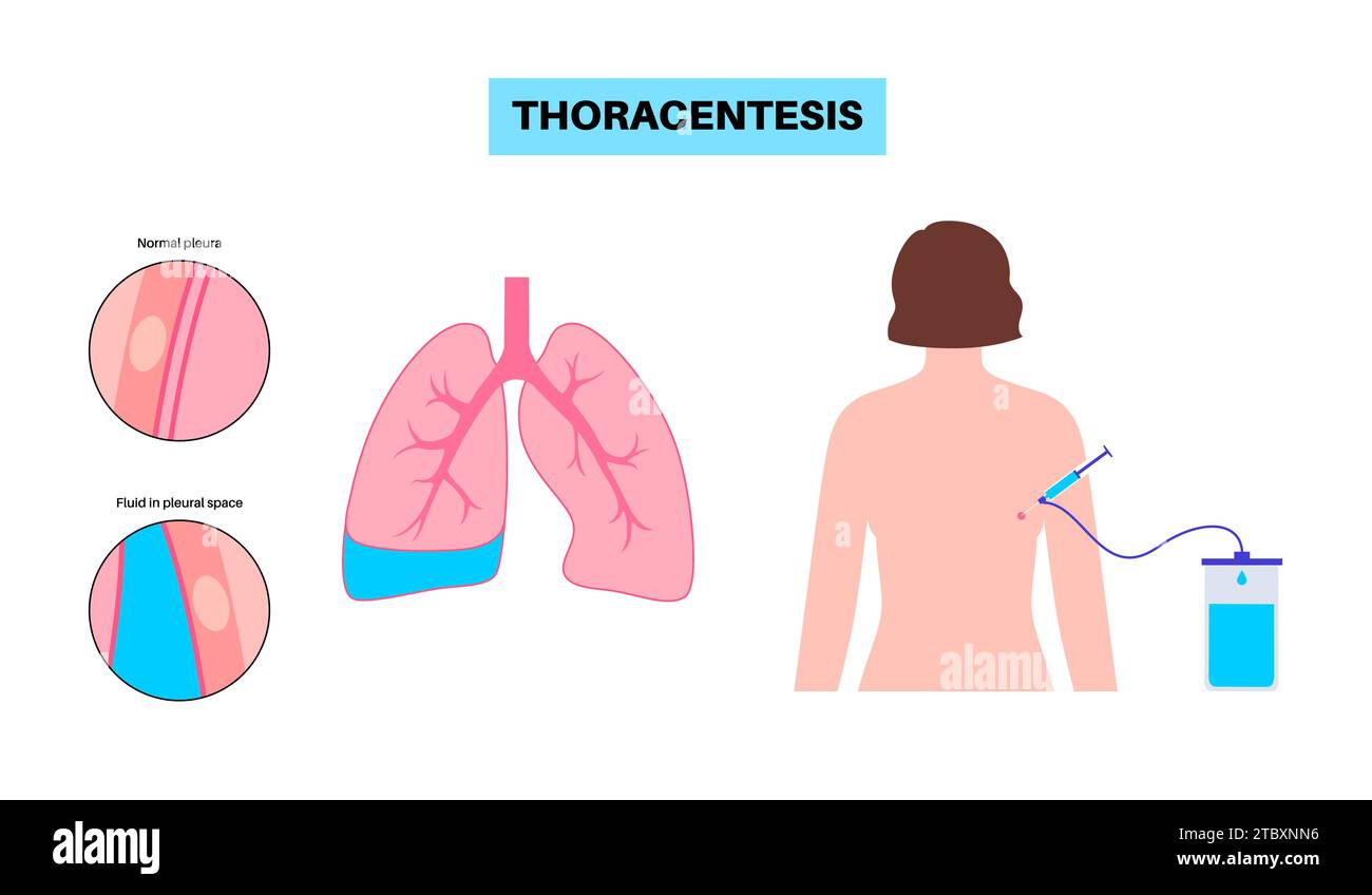 Procedura medica toracentesi, illustrazione Foto Stock
