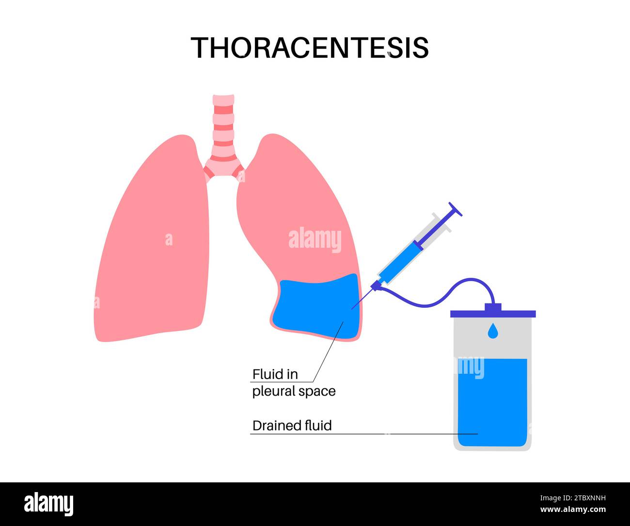 Procedura medica toracentesi, illustrazione Foto Stock