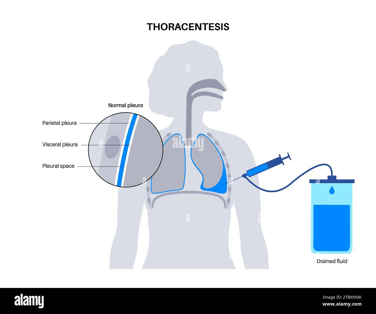 Procedura medica toracentesi, illustrazione Foto Stock