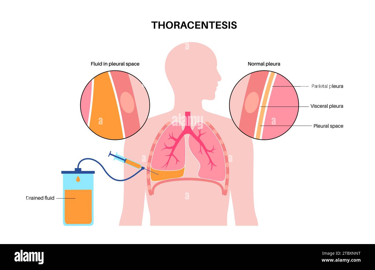 Procedura medica toracentesi, illustrazione Foto Stock