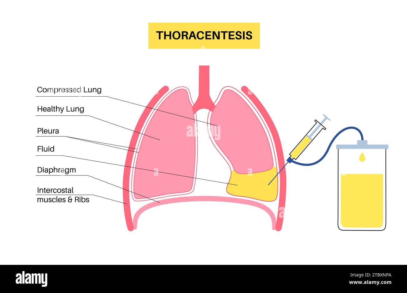Procedura medica toracentesi, illustrazione Foto Stock