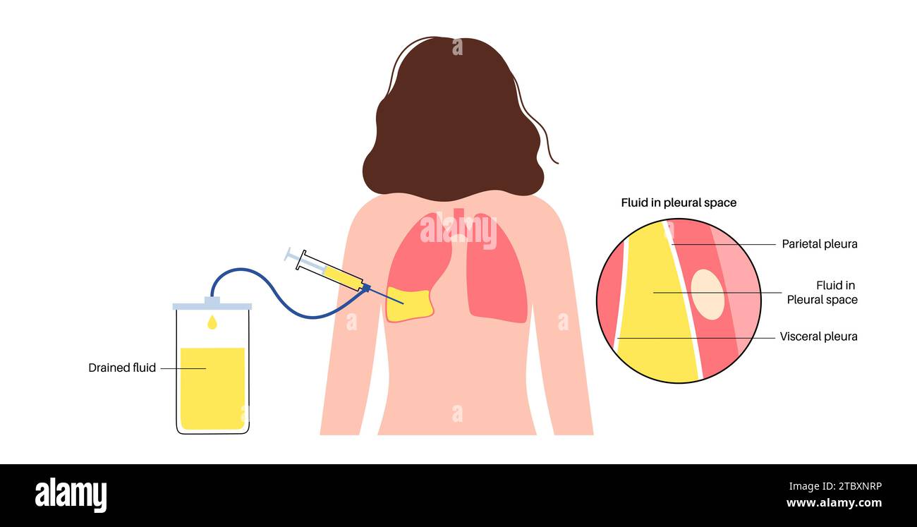 Procedura medica toracentesi, illustrazione Foto Stock