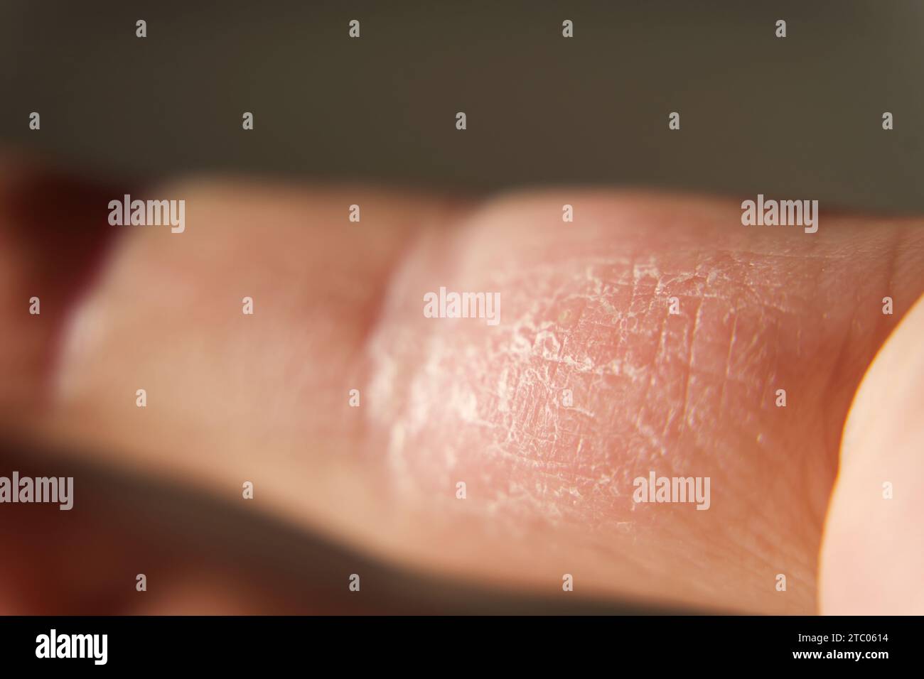 Vista macro di danni causati da eczema cutaneo sul dito del puntatore. Foto Stock