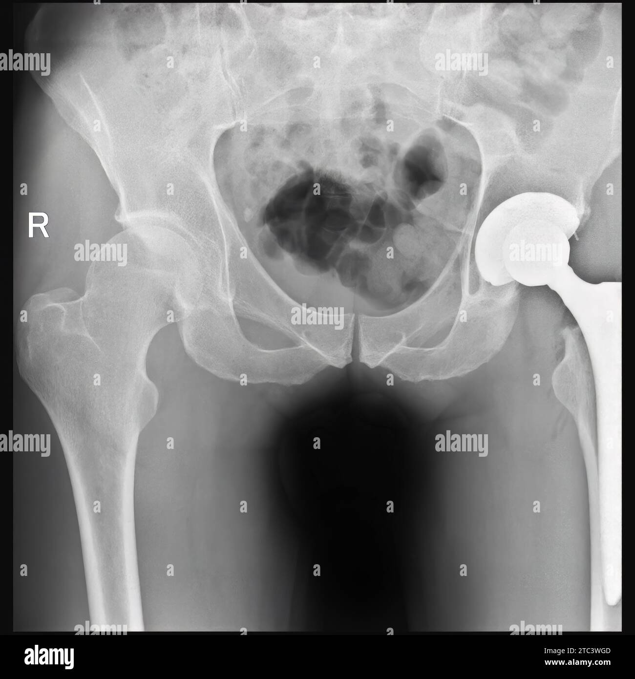 Frattura del collo femorale sinistro. Roentgenogram. Il giorno successivo alla sostituzione totale dell'anca Foto Stock