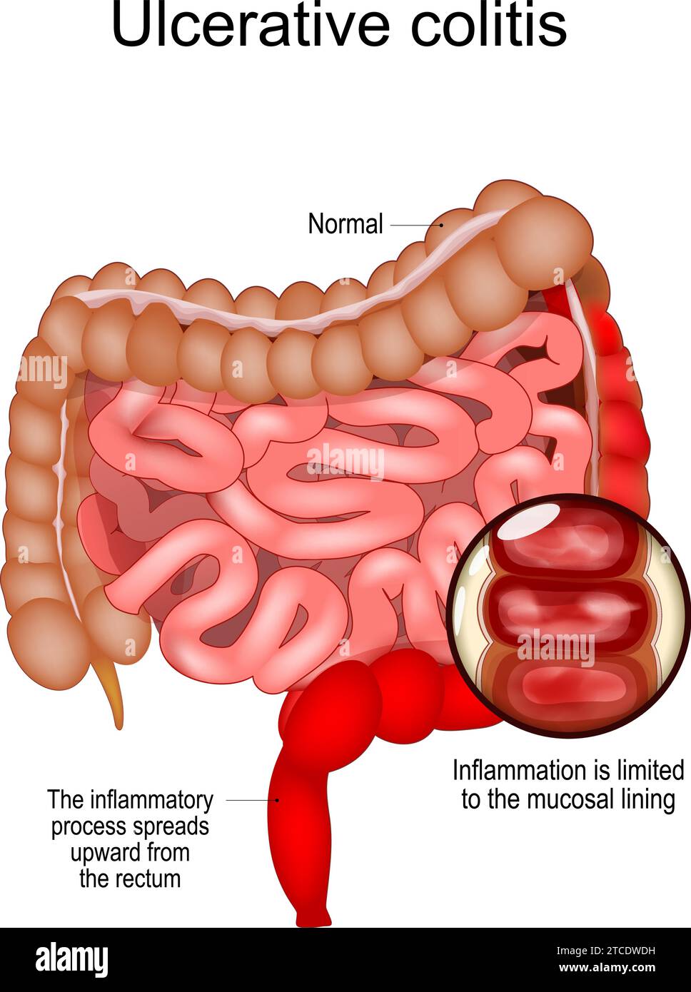 Colite ulcerosa. Malattia infiammatoria intestinale IBD. Intestino crasso e tenue realistico con il processo infiammatorio che si diffonde verso l'alto dal re Illustrazione Vettoriale