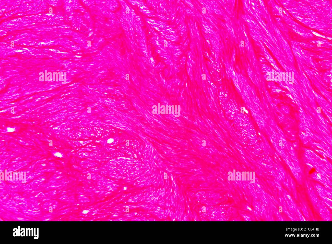 Fibroide uterino umano (tumore benigno). Microscopio ottico X40. Foto Stock