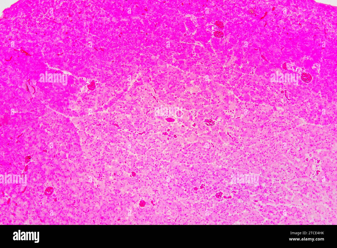 Pancreas umano con diabete mellito di tipo 1 che mostra acina, e isolette di Langerhans. Microscopio ottico X100. Foto Stock